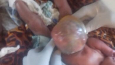Woman appeals for help to treat deformed baby in WES