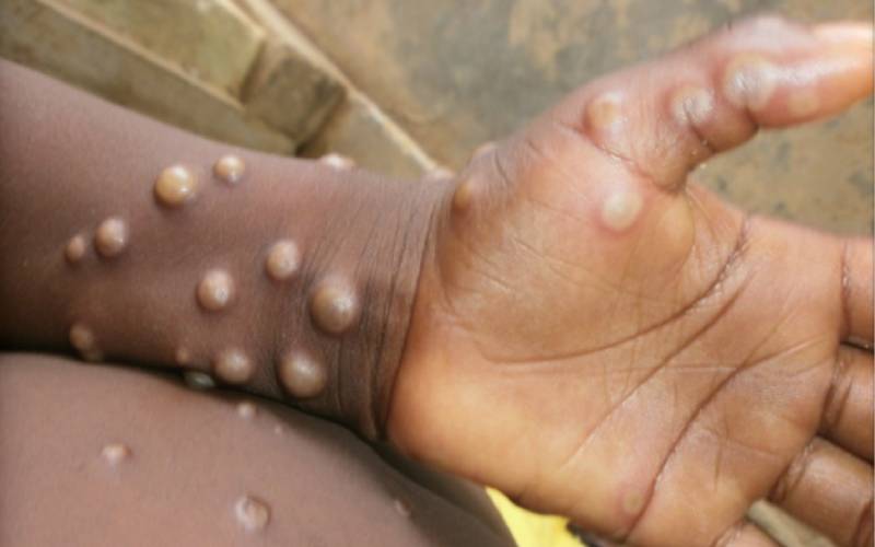 WHO experts name Monkeypox variants
