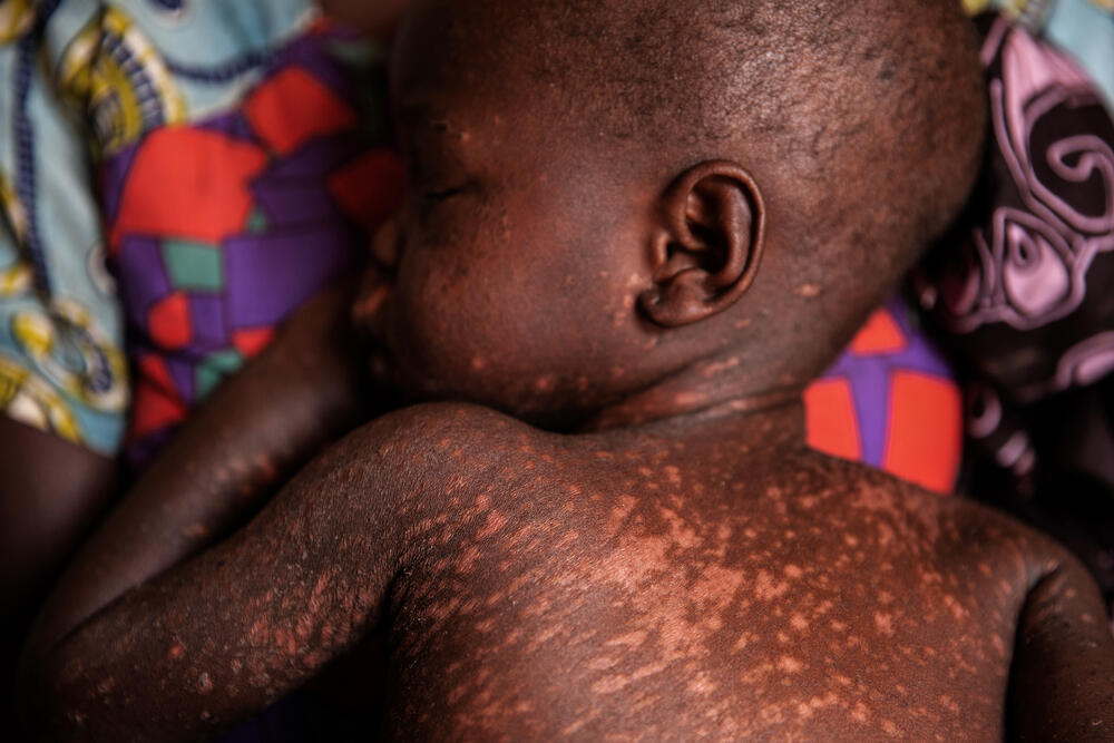 About 1,000 children affected by measles in Kapoeta