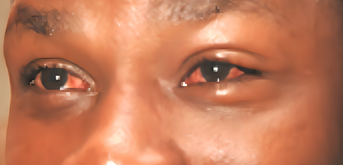 South Sudan registers 382 suspected cases of red eye disease